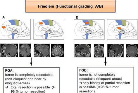 Towards entry "New classification system for brain tumours"