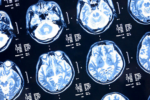 Towards entry "Fatal Huntington's disease already begins in childhood"