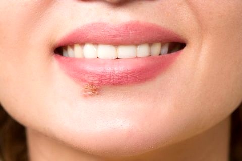 Towards entry "Using the body's own proteins to fight herpes"