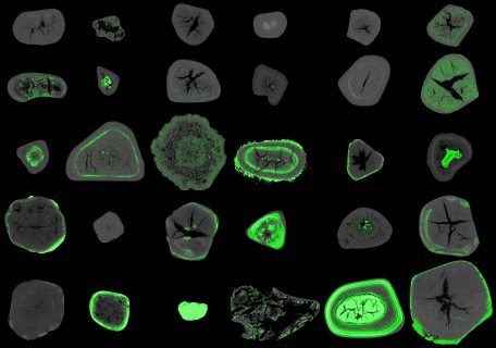 Towards entry "Unlocking the secrets of gallstones"