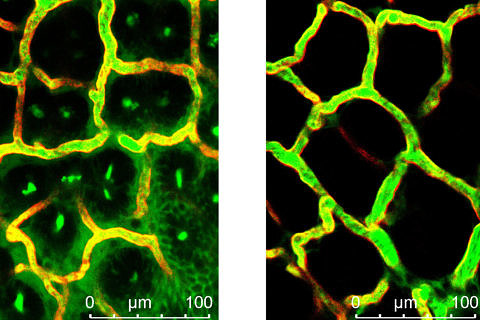 Towards entry "When blood vessels are overly permeable"