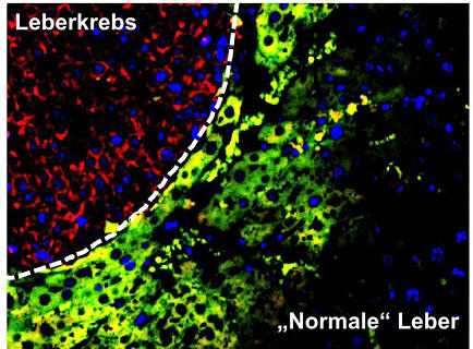 Towards entry "Unlocking new mechanisms behind liver cancer"